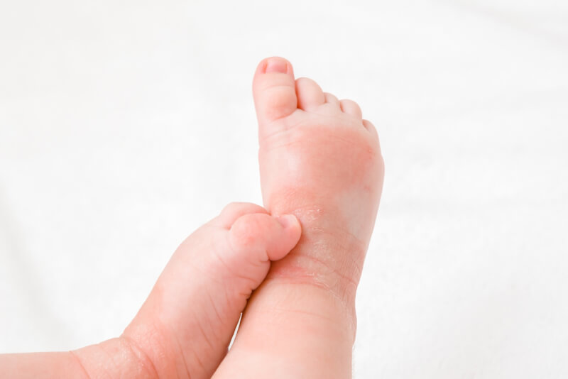 Trẻ em rất dễ bị viêm da cơ địa ở chân