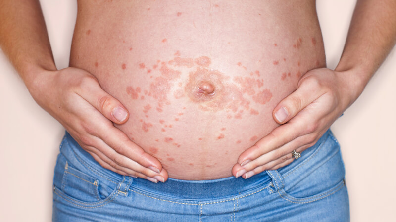 Thời kỳ mang thai các mẹ dễ mắc những bệnh về da so sức đề kháng kém hơn