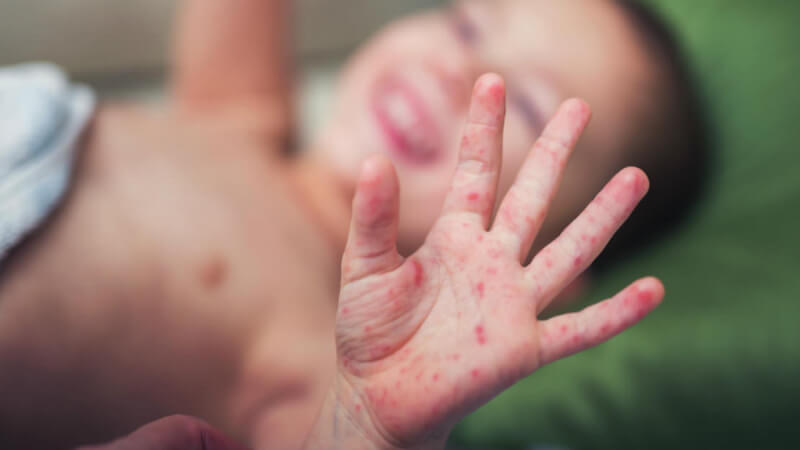 Bất kỳ ai cũng có thể mắc phải viêm da tiếp xúc ở tay
